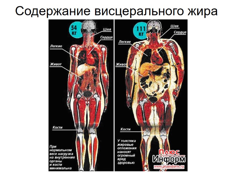Содержание висцерального жира